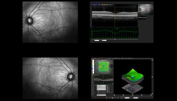 What is Optical Coherence Tomography (OCT) Scan?